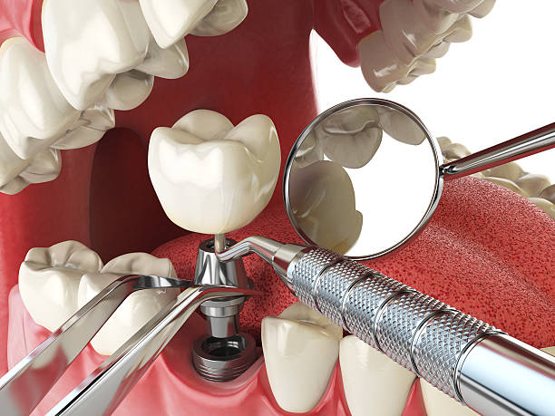 Best Emergency Dentist for Lost Fillings or Crowns in Big Stone Gap, VA